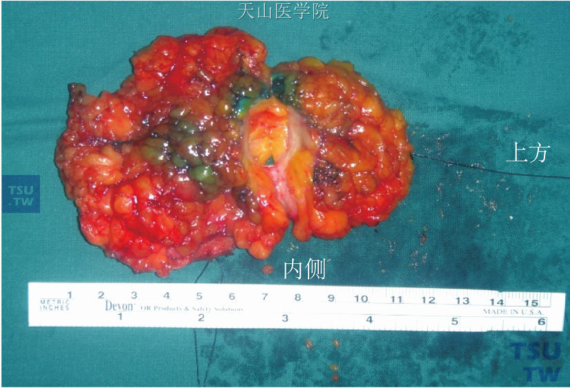 保乳手术乳房肿瘤切除标本，以手术线标记方位，1根丝线为上方，2根丝线为内侧，以便病理检测切缘时能明确标本方位