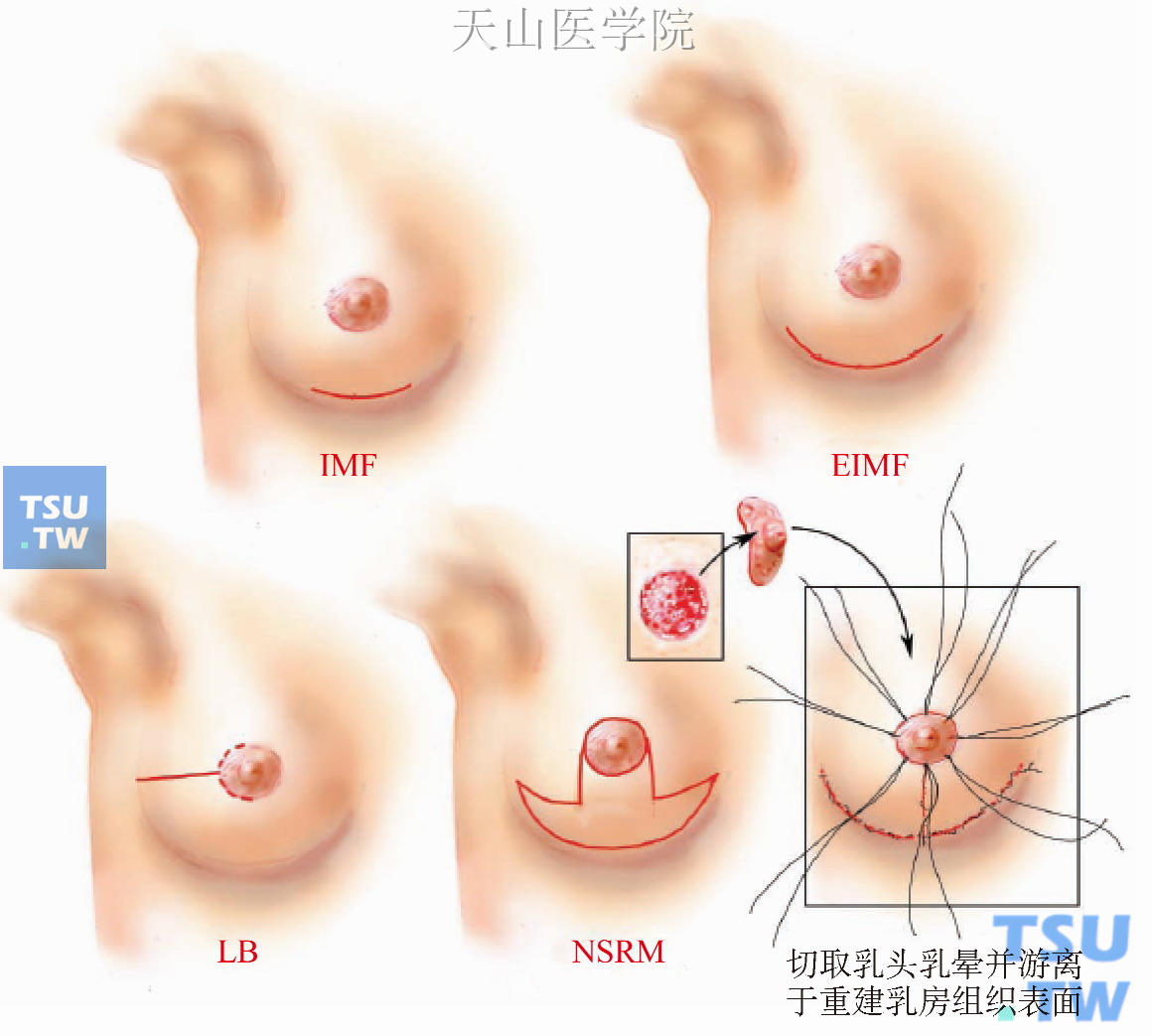 保留乳头的手术切口选择