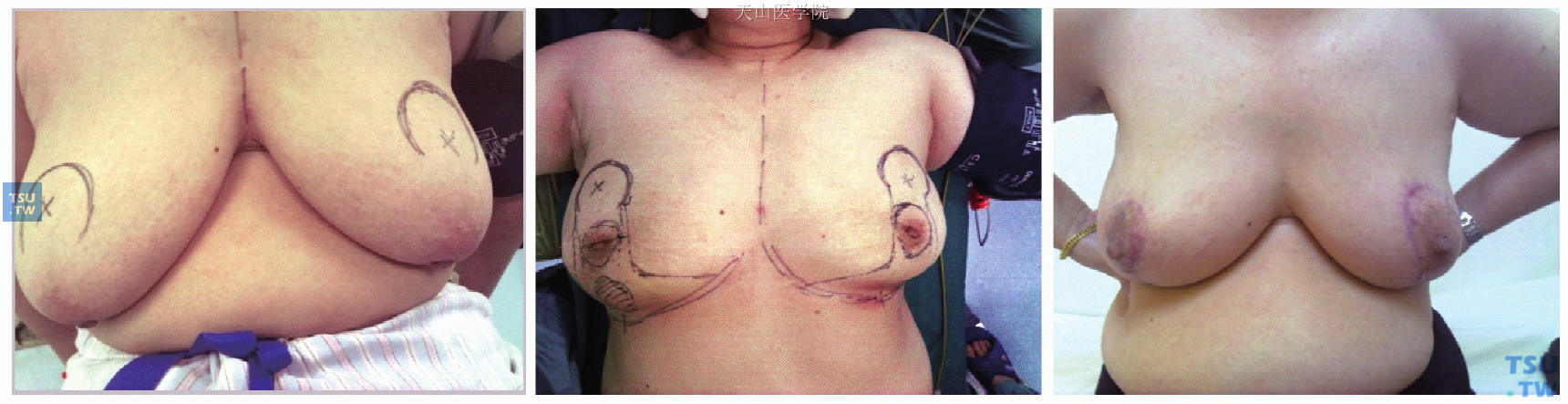 同期行保乳术和双侧乳房缩乳成形术