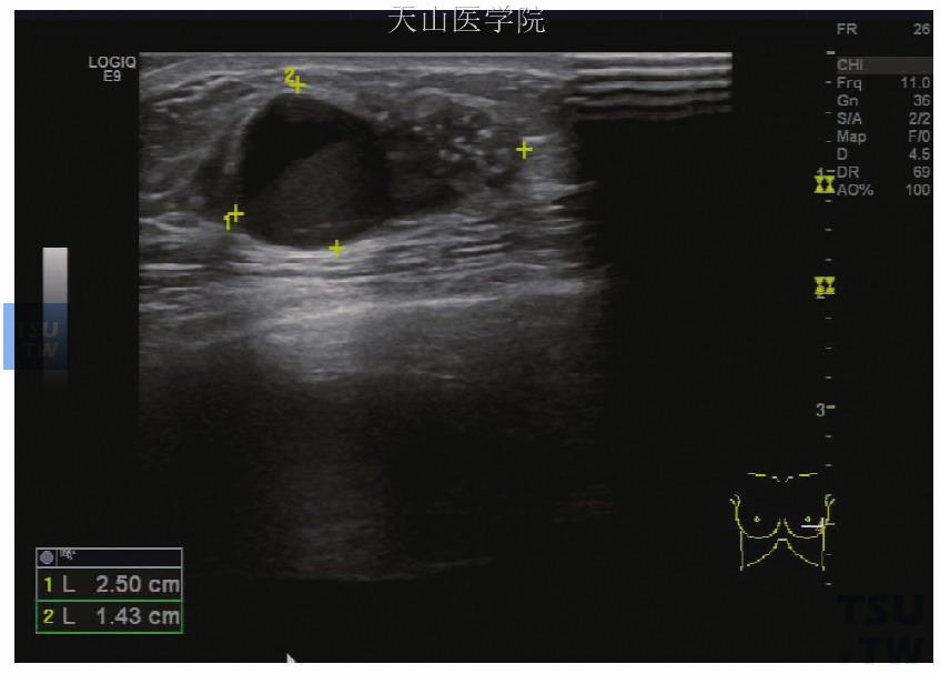 男性乳腺癌的超声影像