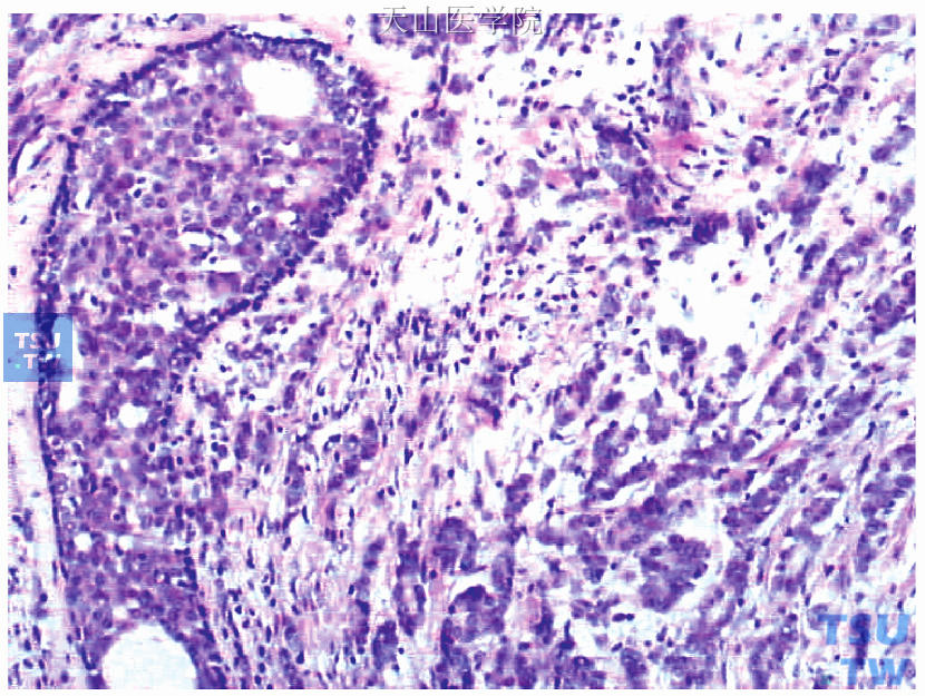 右侧乳腺内上肿块为非特殊型浸润性导管癌Ⅱ级，图左侧见导管原位癌成分