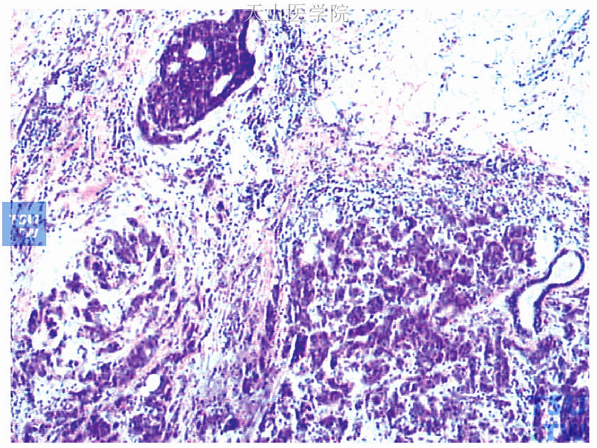 左侧乳腺中上肿块为非特殊型浸润性导管癌Ⅱ级，图上方见导管原位癌成分