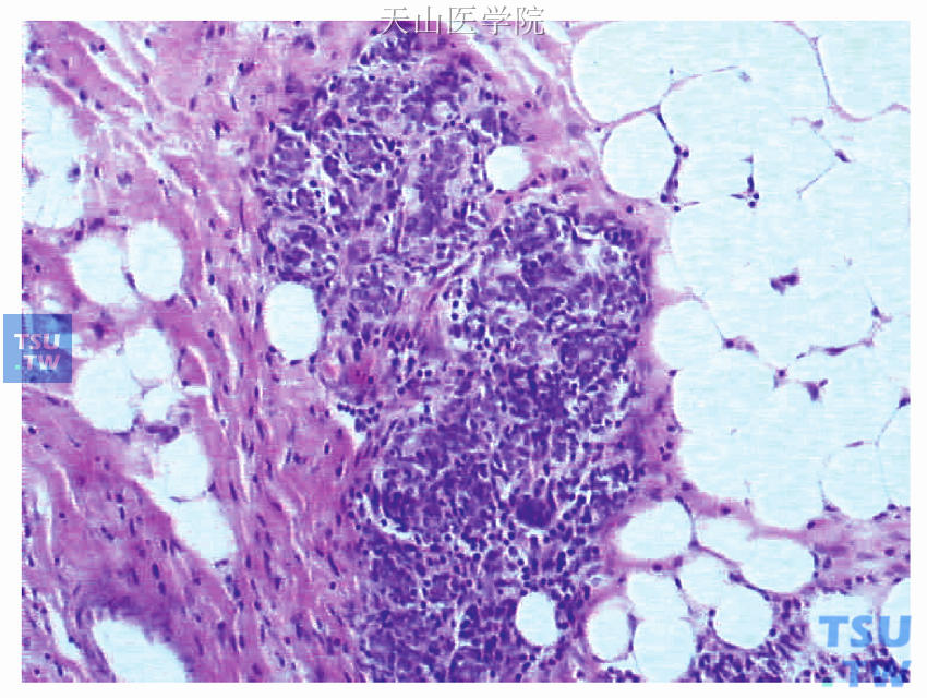 为图48-7上方的放大图像，示癌巢周边残存的正常乳腺组织