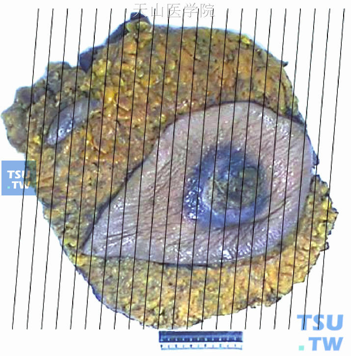 右侧乳腺癌根治术Ⅱ标本取材