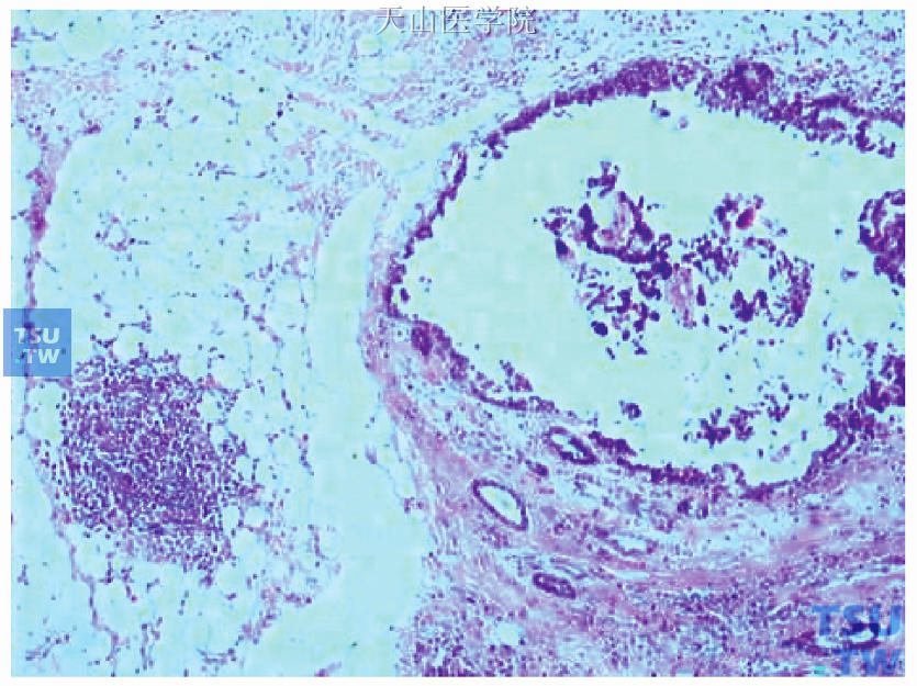 为图48-11右侧延续部分，示乳头状型导管原位癌及周边的正常乳腺导管（图右侧）