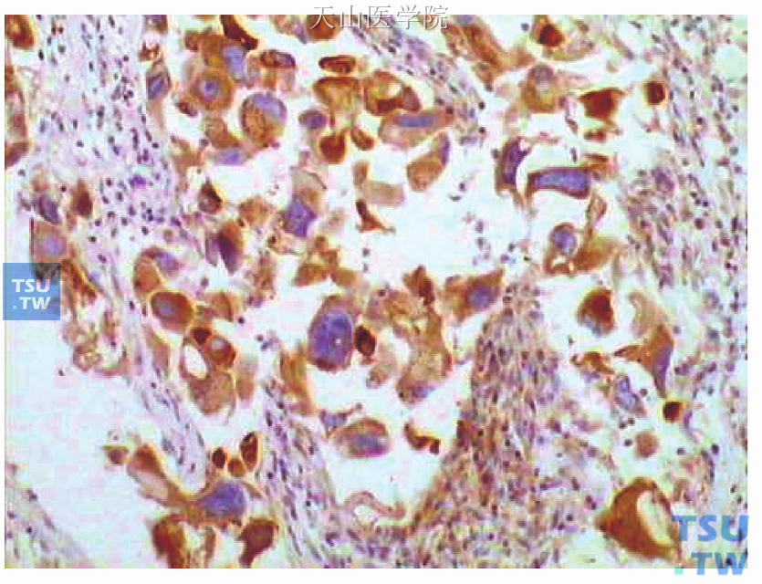 为图48-11连续切片的GCDFP-15免疫组化染色，癌细胞胞质阳性