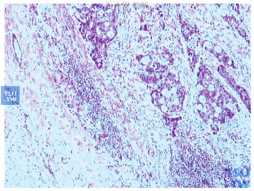 右腋下肿块为浸润性导管癌Ⅱ级（图右侧）及周边残存正常乳腺导管（图左侧）