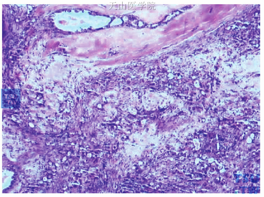 左侧乳腺内上及乳晕区肿块癌细胞呈化疗反应I度改变，图上方见导管原位癌成分
