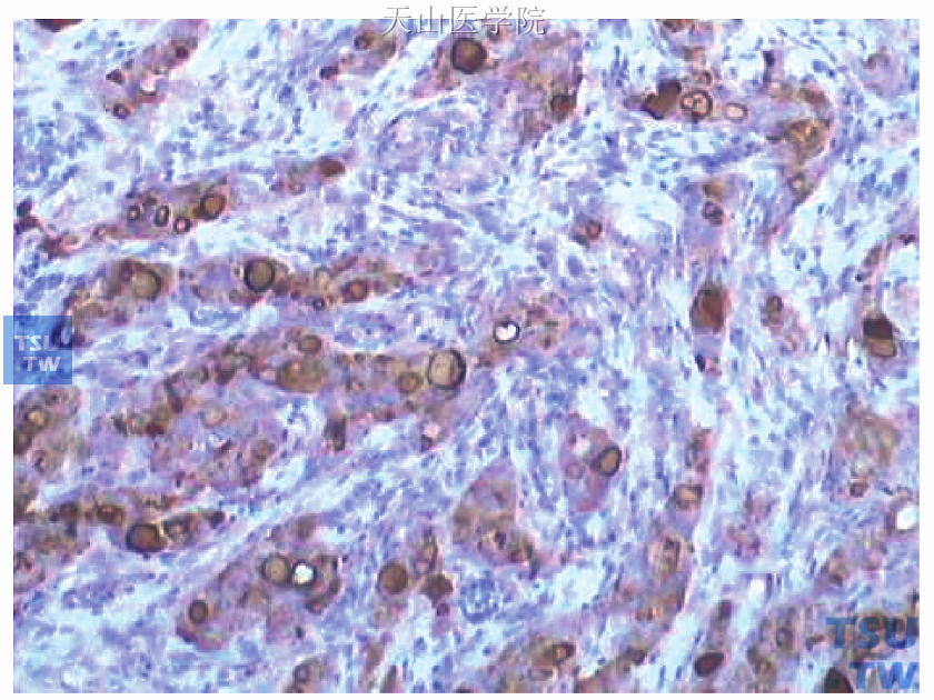 为图48-15连续切片的GCDFP-15免疫组化染色，癌细胞胞质阳性