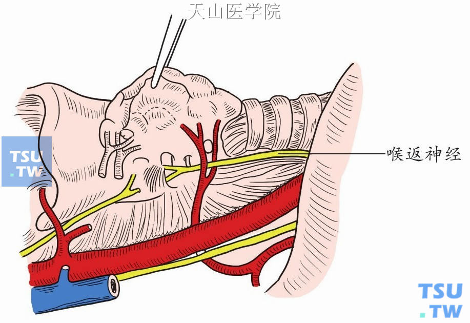 喉返神经于甲状软骨下角入喉处