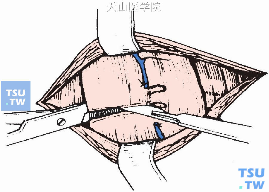 颈前肌予以切断