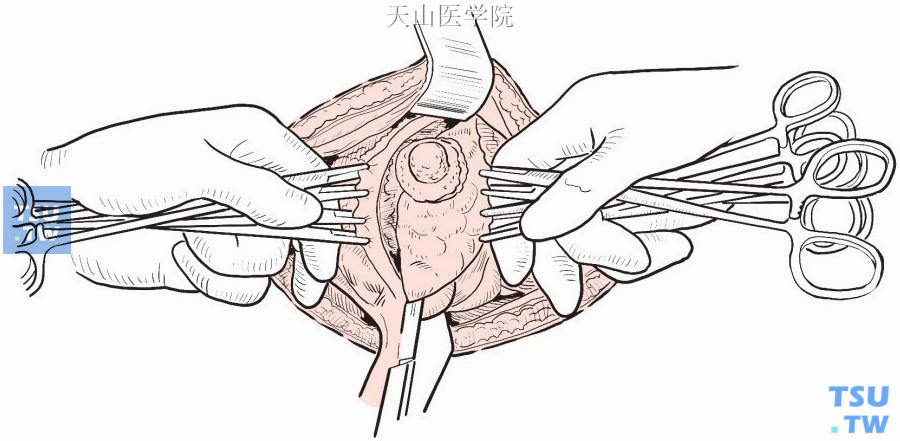 腺体连同病变区做楔形切除