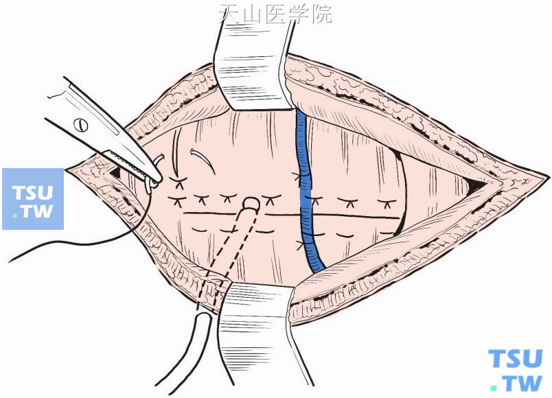 一般不放置引流，如渗血较多，可于腺体切口处放置皮片或皮片管引流，由皮肤切口引出，以4号丝线间断缝合颈前肌及筋膜