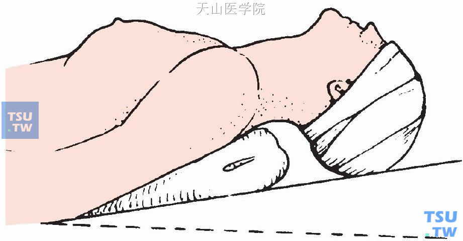 可将手术台头端抬高15°～30°，保持头颈部高于躯干及足部