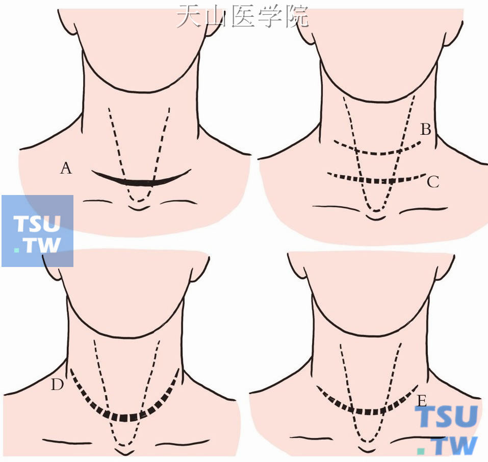 切口弧形呈两侧对称（A），切口太高隐蔽性差（B），切口太直不易与颈部皱纹吻合（C），切口若太呈马蹄形则隐蔽性差（D），由于腺体大小不等而致切口不对称时，切口对侧应予抬高（E）