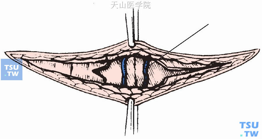 颈阔肌切开向上下分开，显露颈前肌群及颈前静脉