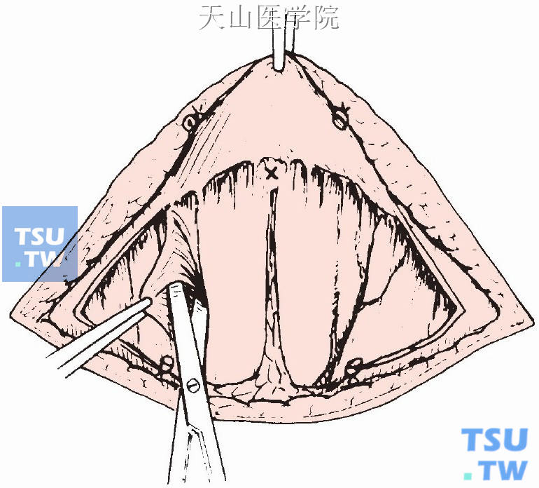 胸锁乳突肌前缘进行分离，使胸锁乳突肌内侧面充分游离