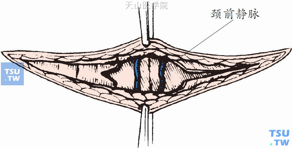 将颈前肌与其下面的甲状腺组织分离