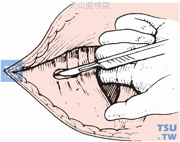 切断颈前肌