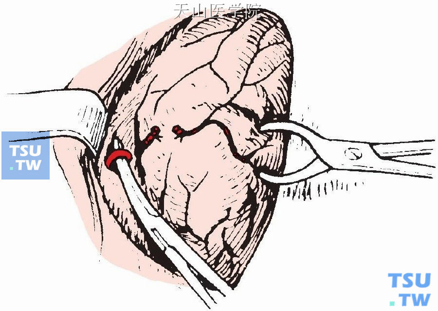 也有主张在甲状腺筋膜外面、颈总动脉内侧，结扎甲状腺下动脉干而不予切断。这样既可以防止喉返神经损伤，又可保证甲状旁腺的血运