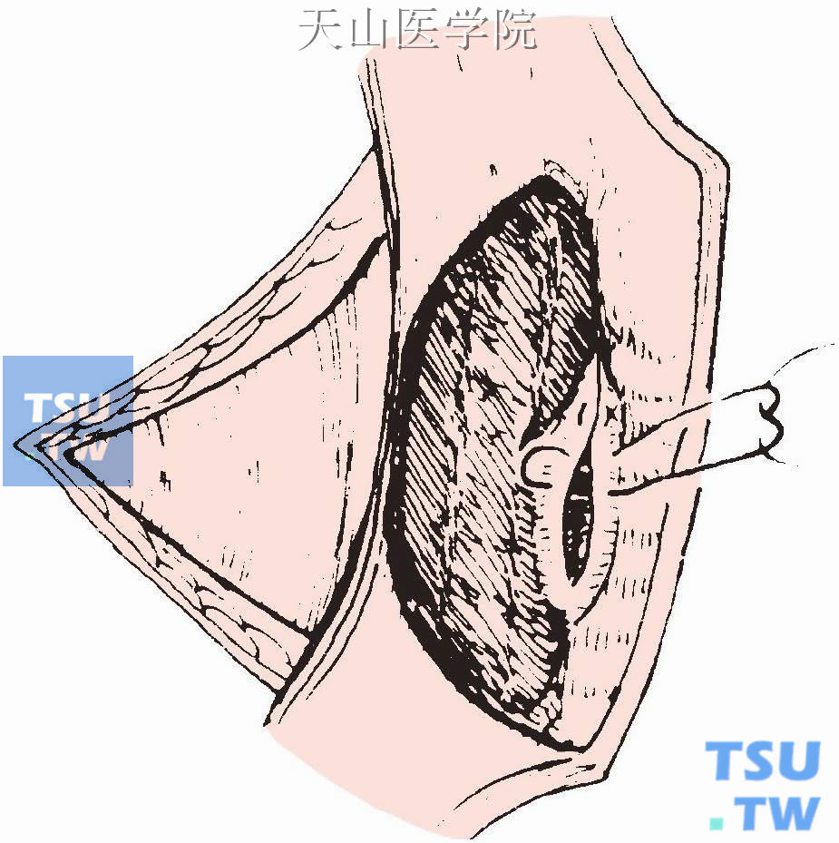 间断缝合两侧边缘的包膜