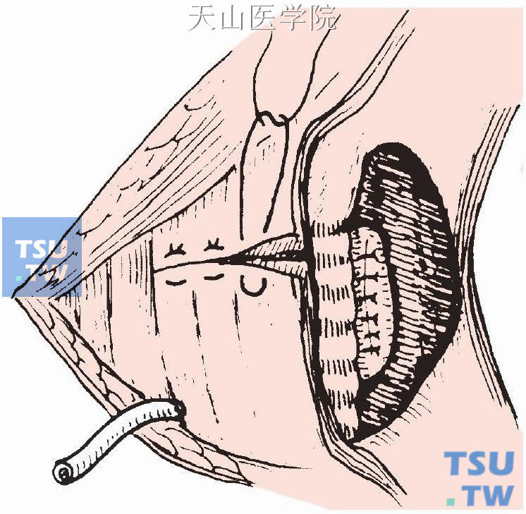 颈前肌上下两端间断褥式缝合