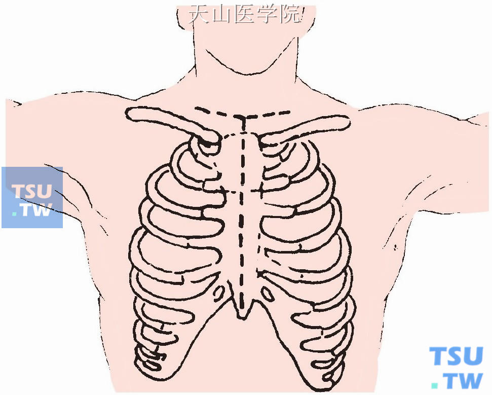 对大的胸骨后甲状腺肿，特别是与纵隔粘连者，则加做胸骨正中切开。实际上这种情况非常少见。