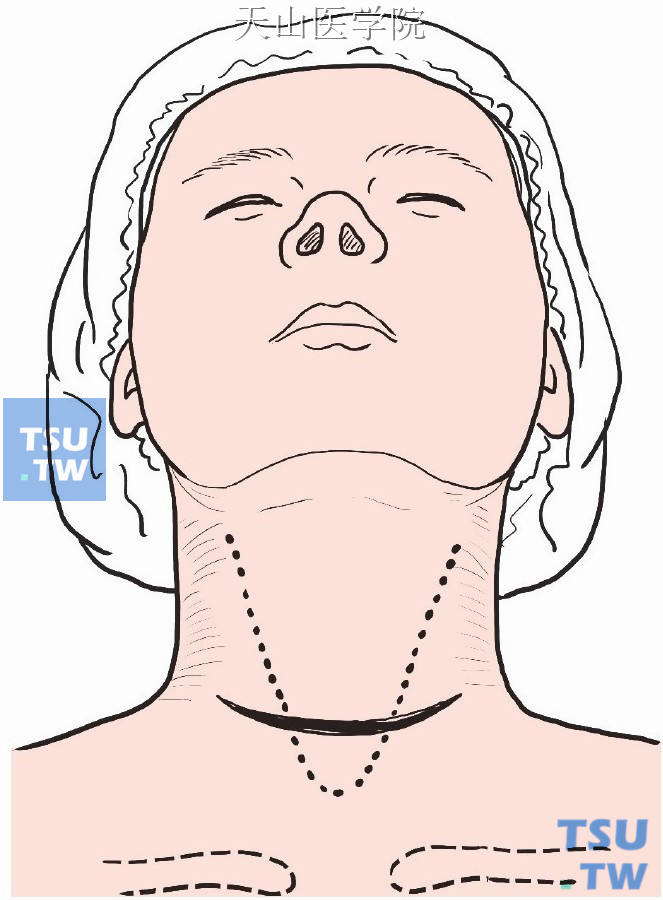 取颈前胸骨切迹上一横指沿皮纹做弧形切口，达两侧胸锁乳突肌后缘