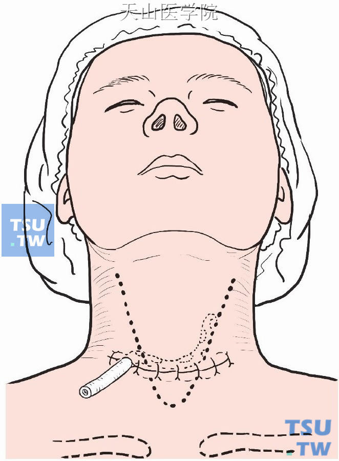 逐层缝合中线、颈阔肌与皮肤