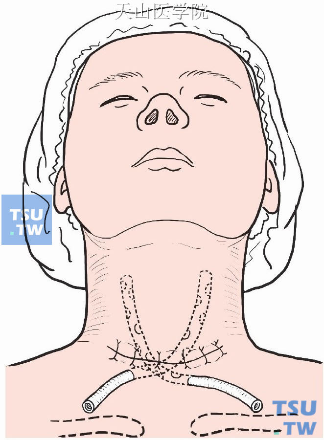 全甲状腺切除及其附近淋巴结清除术