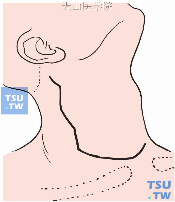 从乳突起向下向前做两个“Z”形切口，然后与甲状腺原发灶手术的领式切口相接呈“之”字形状（右侧）
