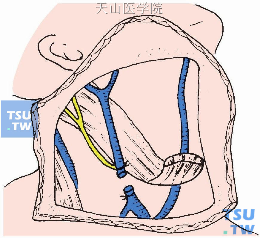 结扎切断颈外静脉锁骨下段，切断胸锁乳突肌起点