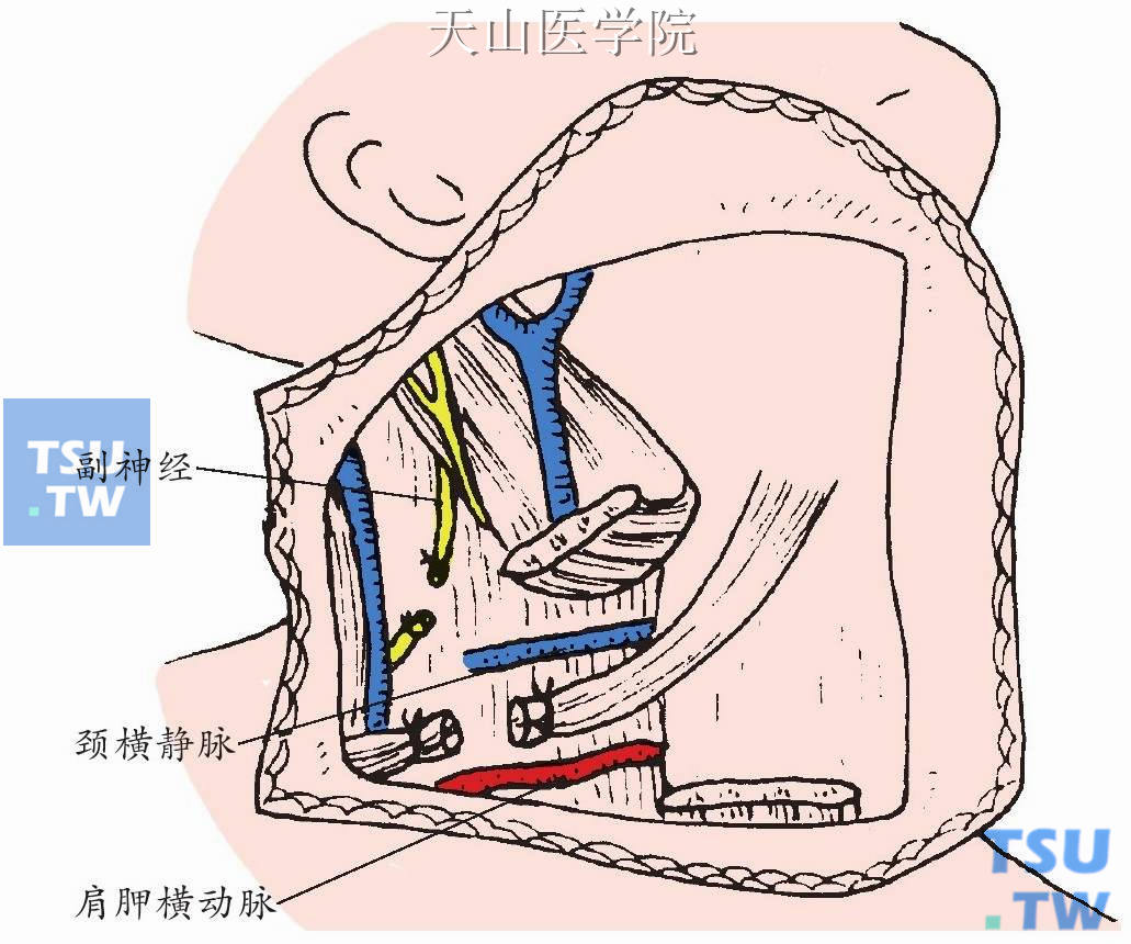 肩胛舌骨肌下腹切断，切断副神经