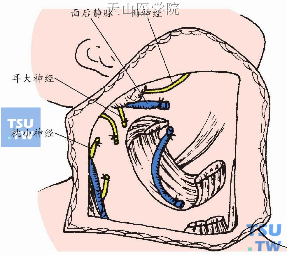 在胸锁乳突肌上段下缘切断枕小神经，结扎切断颈外静脉后将胸锁乳突肌止点段从椎前筋膜上分离