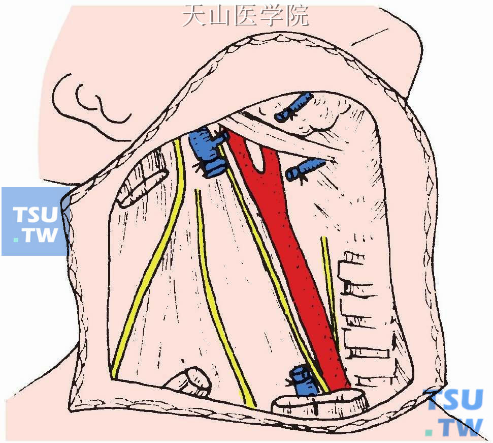 切断舌、咽静脉，切断肩胛舌骨肌