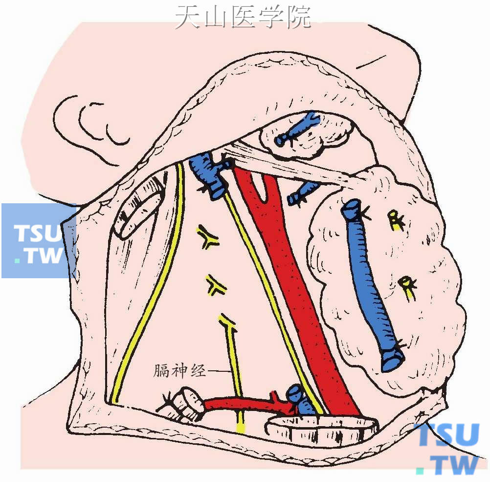 将整个颈侧部清除组织包括Ⅱ、Ⅲ、Ⅳ及Ⅴ区淋巴结，颈内静脉、副神经、胸锁乳突肌、肩胛舌骨肌与枕小神经、耳大神经、颈皮神经及锁骨上神经一起从颈总、颈内（外）动脉的浅面清除至它们的前缘