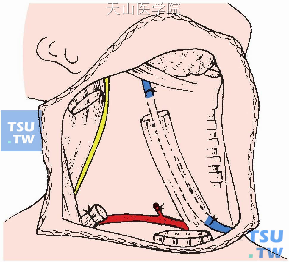 结扎切断颈前静脉，切断胸骨舌骨肌与胸骨甲状肌