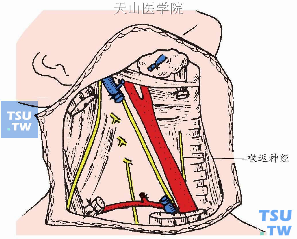 在保留喉返神经与甲状旁腺情况下清除Ⅵ区淋巴结，与前已清除的颈动脉后的颈侧组织相接整块地完成清除术