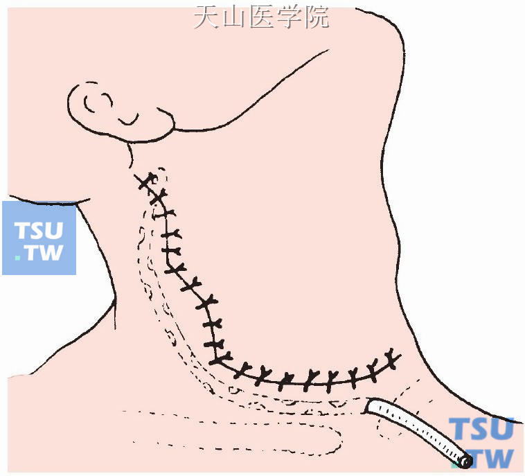 先缝合颈阔肌试行负压吸引，无漏气后再缝合皮肤层