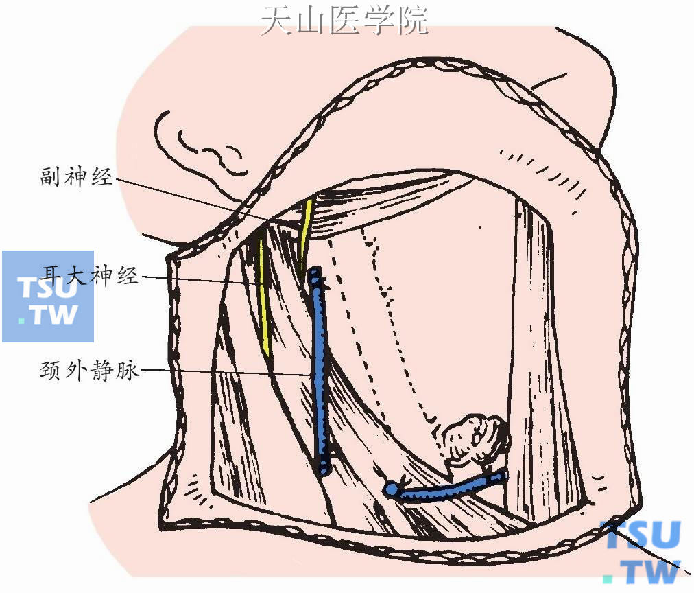 游离达乳突附近时横断后肌膜，使胸锁乳突肌除起止点外均游离