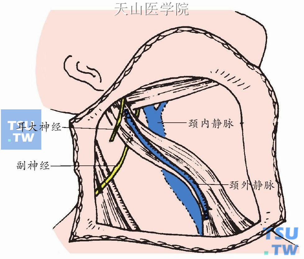 在清除颈后三角前先找到副神经加以游离保护