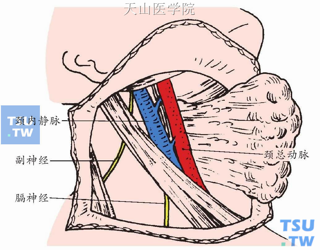 贴近颈内静脉前缘结扎切断进入此静脉的面总静脉和甲状腺上、中静脉，使颈内静脉全长游离