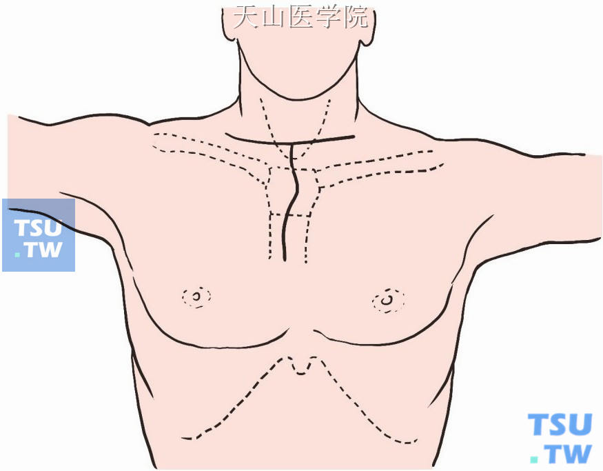 “甲状腺腺叶切除及其附近淋巴结清除术”做颈前胸骨切迹上一横指弧形切口