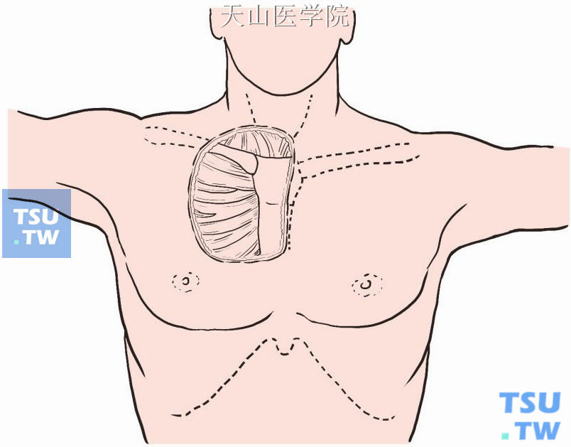 在转移灶侧颈阔肌深面行上胸瓣分离显露该侧内1/2锁骨、胸骨柄与第1、2肋软骨