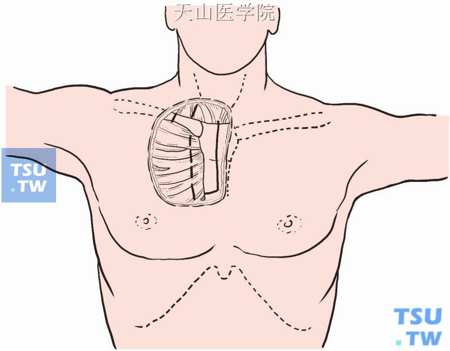 甲状腺癌前上纵隔淋巴结清除术