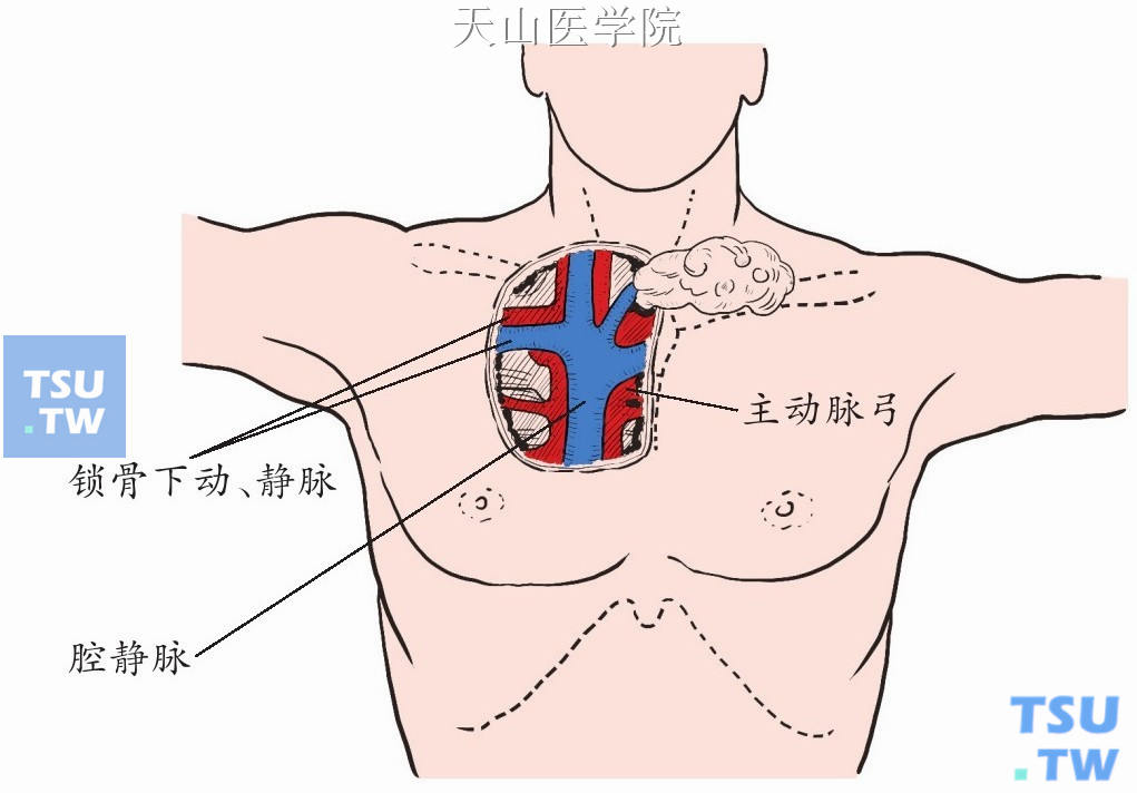 从锁骨下静脉远心端向心分离显露它与颈内静脉、无名静脉的汇合处；在右侧进一步显露无名动脉与上腔静脉