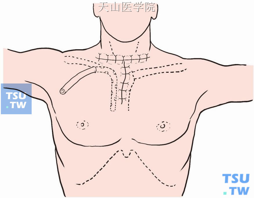 分层缝合颈阔肌与皮肤，不另置皮片等引流物