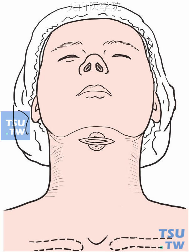 在甲状腺舌管囊肿上做一横切口，长约5cm