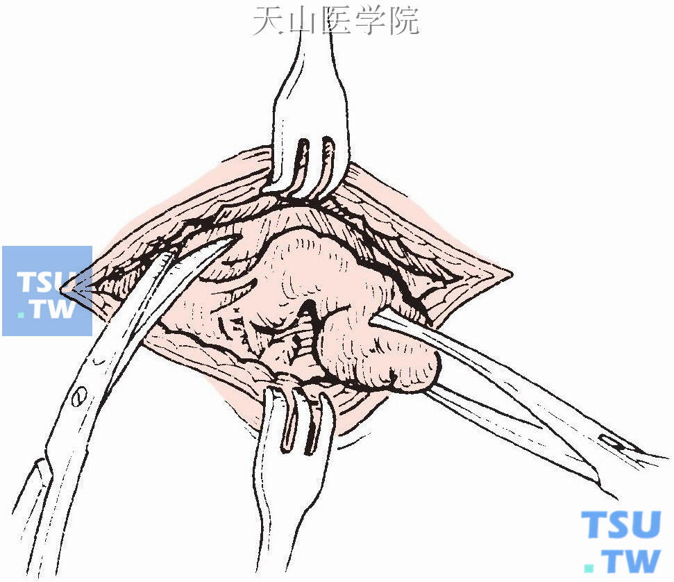 仔细将囊肿从周围组织分离，至囊肿基底部时沿管道继续分离至舌骨
