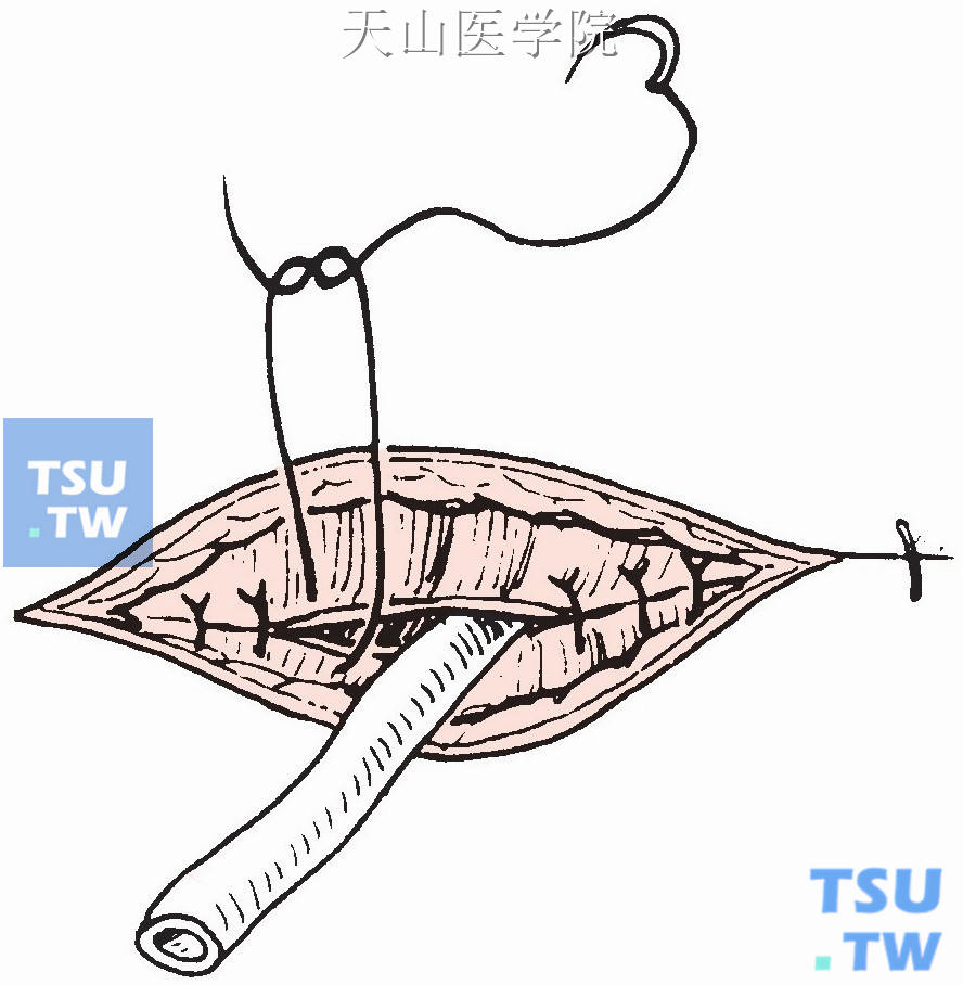 创口止血后置橡皮片引流，以丝线间断缝合颈阔肌和皮肤